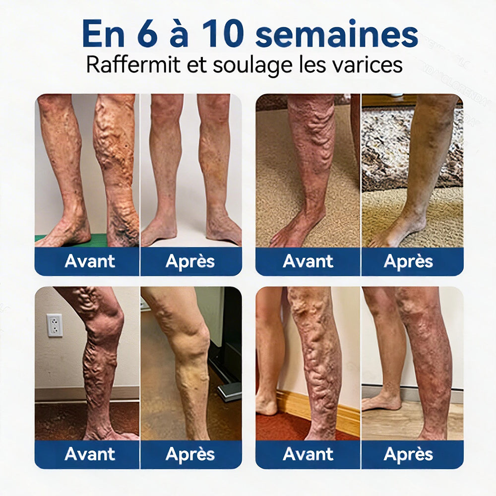 𝐏𝐮𝐫𝐞𝐥𝐨𝐫𝐚® 𝐏𝐚𝐭𝐜𝐡 𝐌𝐢𝐜𝐫𝐨-𝐀𝐢𝐠𝐮𝐢𝐥𝐥𝐞𝐬 𝐂𝐨𝐧𝐭𝐨𝐮𝐫 𝐝𝐞𝐬 𝐕𝐞𝐢𝐧𝐞𝐬 𝐚𝐮 𝐃𝐢𝐨𝐬𝐦𝐢𝐧𝐞 & 𝐀𝐞𝐬𝐜𝐢𝐧𝐞 🌿𝐑é𝐬𝐮𝐥𝐭𝐚𝐭𝐬 𝐯𝐢𝐬𝐢𝐛𝐥𝐞𝐬 𝐜𝐨𝐧𝐭𝐫𝐞 𝐥𝐞𝐬 𝐯𝐚𝐫𝐢𝐜𝐞𝐬 𝐞𝐧 𝟕 𝐣𝐨𝐮𝐫𝐬 – 𝐅𝐨𝐫𝐦𝐮𝐥𝐞 𝐯é𝐠é𝐭𝐚𝐥𝐞 𝐚𝐯𝐚𝐧𝐜é𝐞 𝐜𝐢𝐛𝐥𝐚𝐧𝐭 𝐥𝐞𝐬 𝐯𝐚𝐫𝐢𝐜𝐨𝐬𝐢𝐭é𝐬 𝐞𝐭 𝐬𝐨𝐮𝐥𝐚𝐠𝐞𝐚𝐧𝐭 𝐥𝐞𝐬 𝐣𝐚𝐦𝐛𝐞𝐬 𝐥𝐨𝐮𝐫𝐝𝐞𝐬 𝐞𝐭 𝐟𝐚𝐭𝐢𝐠𝐮é𝐞𝐬