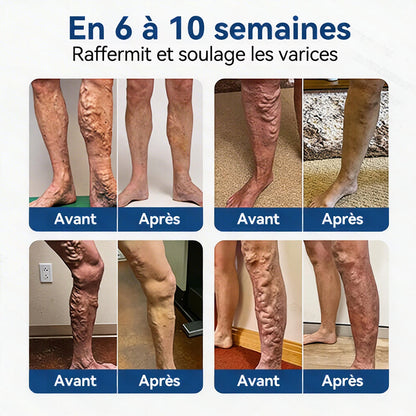 𝐏𝐮𝐫𝐞𝐥𝐨𝐫𝐚® 𝐏𝐚𝐭𝐜𝐡 𝐌𝐢𝐜𝐫𝐨-𝐀𝐢𝐠𝐮𝐢𝐥𝐥𝐞𝐬 𝐂𝐨𝐧𝐭𝐨𝐮𝐫 𝐝𝐞𝐬 𝐕𝐞𝐢𝐧𝐞𝐬 𝐚𝐮 𝐃𝐢𝐨𝐬𝐦𝐢𝐧𝐞 & 𝐀𝐞𝐬𝐜𝐢𝐧𝐞 🌿𝐑é𝐬𝐮𝐥𝐭𝐚𝐭𝐬 𝐯𝐢𝐬𝐢𝐛𝐥𝐞𝐬 𝐜𝐨𝐧𝐭𝐫𝐞 𝐥𝐞𝐬 𝐯𝐚𝐫𝐢𝐜𝐞𝐬 𝐞𝐧 𝟕 𝐣𝐨𝐮𝐫𝐬 – 𝐅𝐨𝐫𝐦𝐮𝐥𝐞 𝐯é𝐠é𝐭𝐚𝐥𝐞 𝐚𝐯𝐚𝐧𝐜é𝐞 𝐜𝐢𝐛𝐥𝐚𝐧𝐭 𝐥𝐞𝐬 𝐯𝐚𝐫𝐢𝐜𝐨𝐬𝐢𝐭é𝐬 𝐞𝐭 𝐬𝐨𝐮𝐥𝐚𝐠𝐞𝐚𝐧𝐭 𝐥𝐞𝐬 𝐣𝐚𝐦𝐛𝐞𝐬 𝐥𝐨𝐮𝐫𝐝𝐞𝐬 𝐞𝐭 𝐟𝐚𝐭𝐢𝐠𝐮é𝐞𝐬