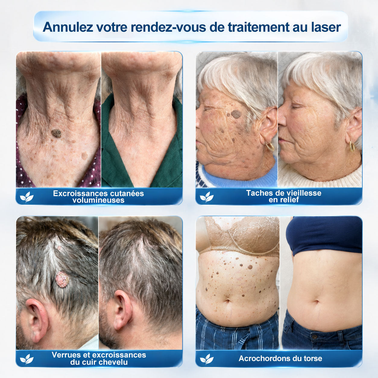 Boutique officielle de la marque | Hudros® 7 Jours Effaceur de taches et d’excroissances cutanées(Zéro douleur, zéro cicatrice – Roller)👍