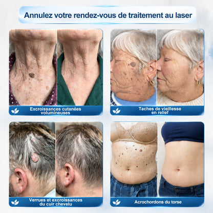 Boutique officielle de la marque | Hudros® 7 Jours Effaceur de taches et d’excroissances cutanées(Zéro douleur, zéro cicatrice – Roller)👍