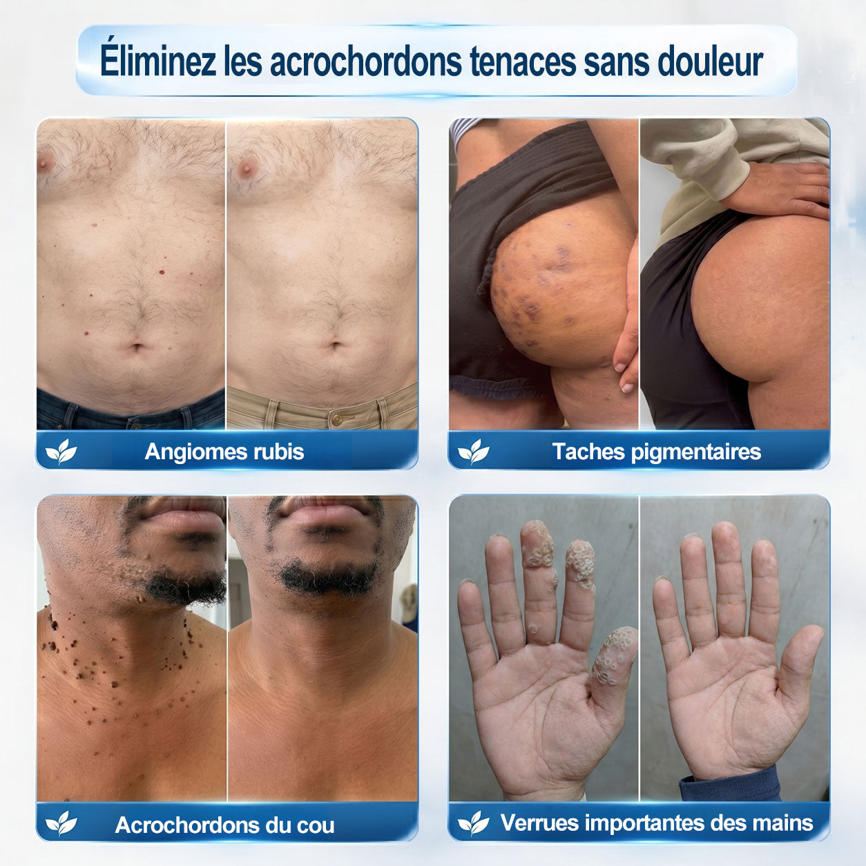 Boutique officielle de la marque | Hudros® 7 Jours Effaceur de taches et d’excroissances cutanées(Zéro douleur, zéro cicatrice – Roller)👍