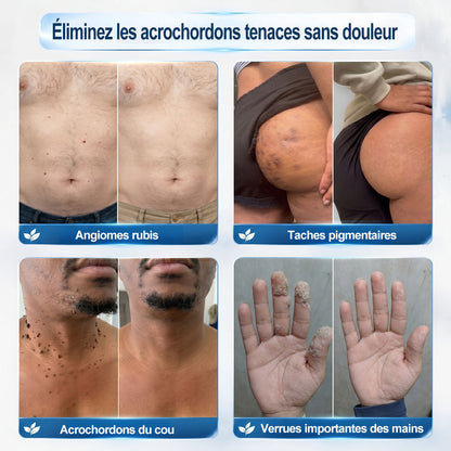Boutique officielle de la marque | Hudros® 7 Jours Effaceur de taches et d’excroissances cutanées(Zéro douleur, zéro cicatrice – Roller)👍
